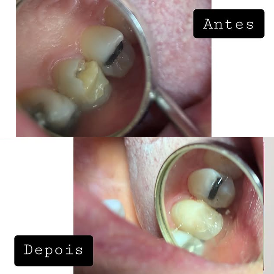 Troca de restauração — antes e depois